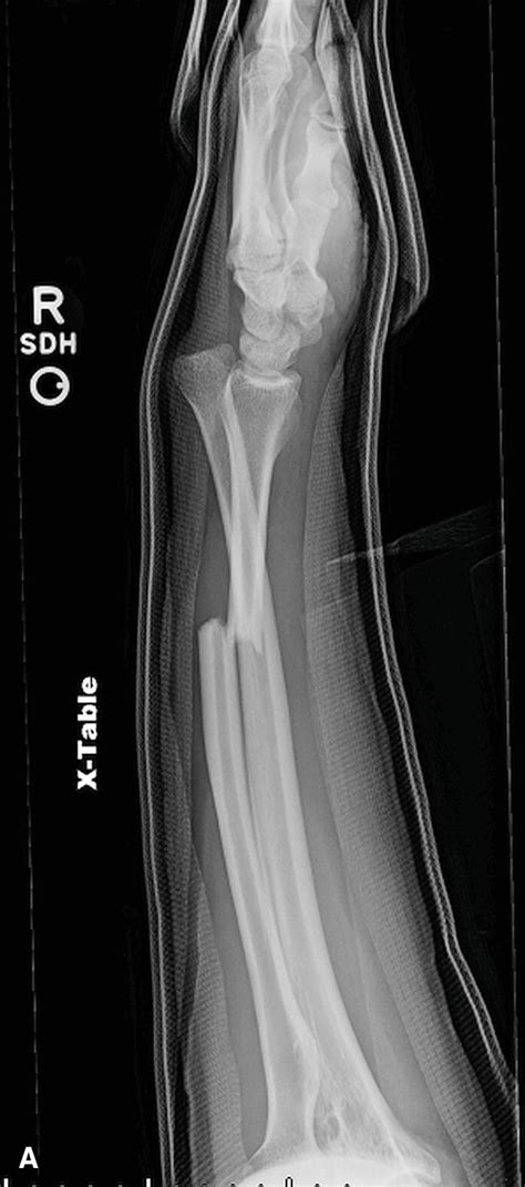 Orif Forearm Fractures Musculoskeletal Key
