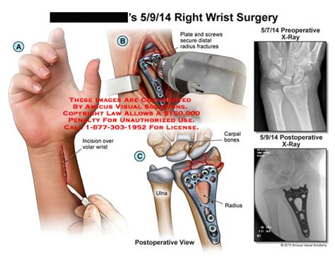 amicus illustration of amicus surgery wrist plate screws distal radius fractures ulna