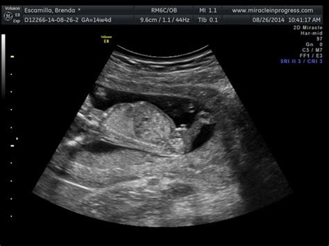 14 Week Ultrasound Boy Or Girl Babycenter