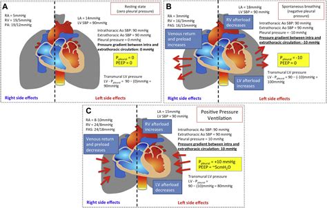 Positive Pressure Ventilation In Cardiogenic Shock Review Of The
