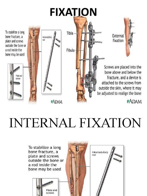 Fixators