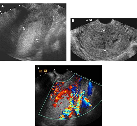 Figure 13 From Sonographic Evaluation Of First Trimester Bleeding
