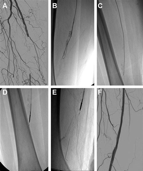 Overview Of New Technologies For Lower Extremity Revascularization