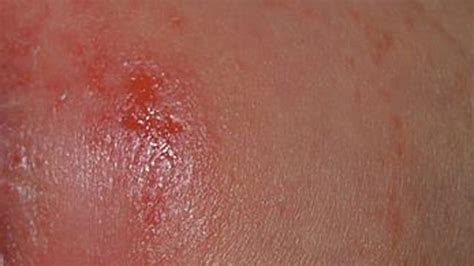 Itchy Red Spot On Skin That Wont Go Away Papular Acrodermatitis