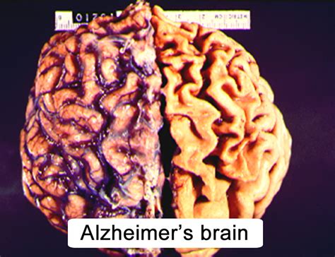 Camels have a large hump, strange knees, skinny legs and ugly teeth. CNS Aging and Alzheimer's Disease (Section 4, Chapter 10 ...