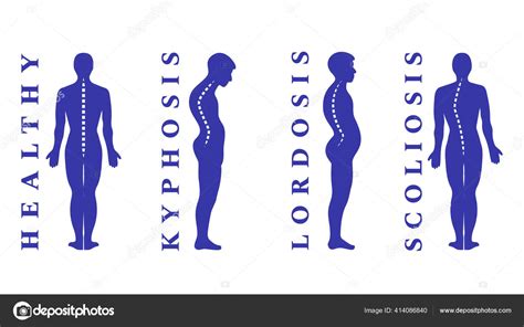 Diseases Spine Scoliosis Lordosis Kyphosis Body Posture Defects Back