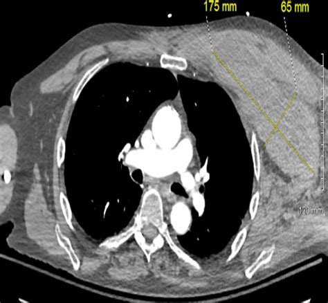 Spontaneous Large Anterior Chest Wall Haematoma Causing Haemorrhagic