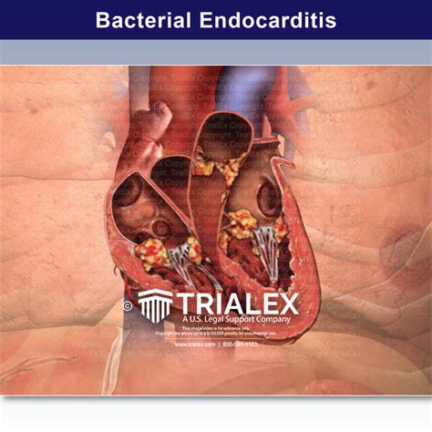 Endocarditis Prosthetic Aortic Valve Trial Exhibits Inc
