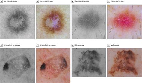 The Role Of Color And Morphologic Characteristics In Dermoscopic