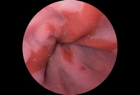 The throat has three areas: Visual Guide to Understanding Heartburn and GERD