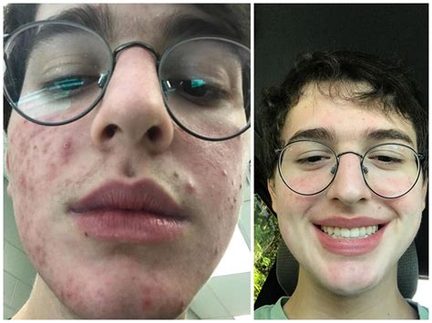 Accutane Before and After 140mg/day : Accutane