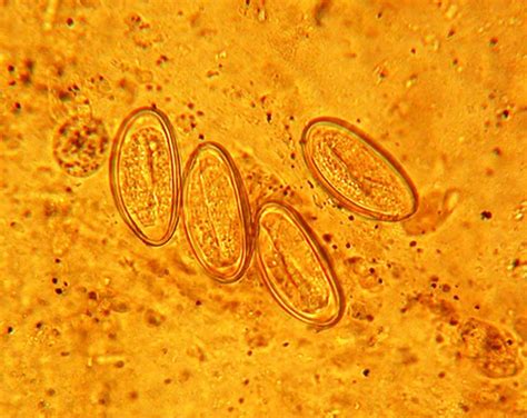Enterobius Vermicularis Infection Of Female Genital Tract Sexually Transmitted Infections