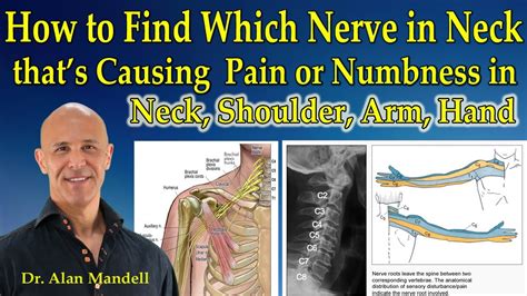 How To Determine Which Nerve In Neck Thats Causing Pain Or Numbness In