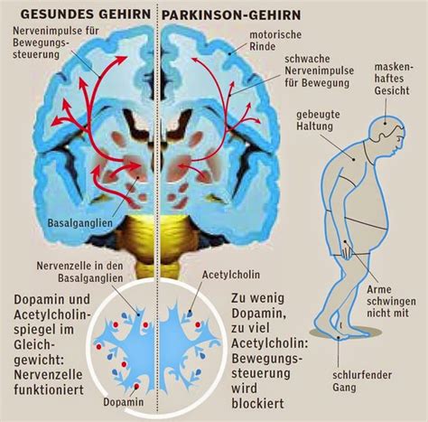 Parkinson Ips Idiopathischen Parkinson Schüttelkrankheit