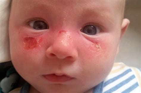 Four Month Old Baby Left With Blisters On His Swollen Face After