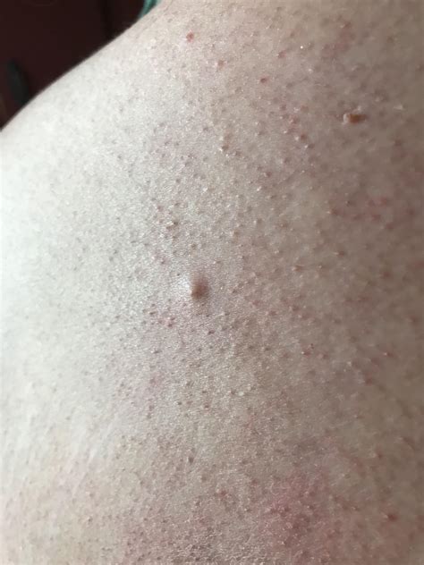 Painless Lump Under Skin On Back Not A Pimple Has Been There For 3 4