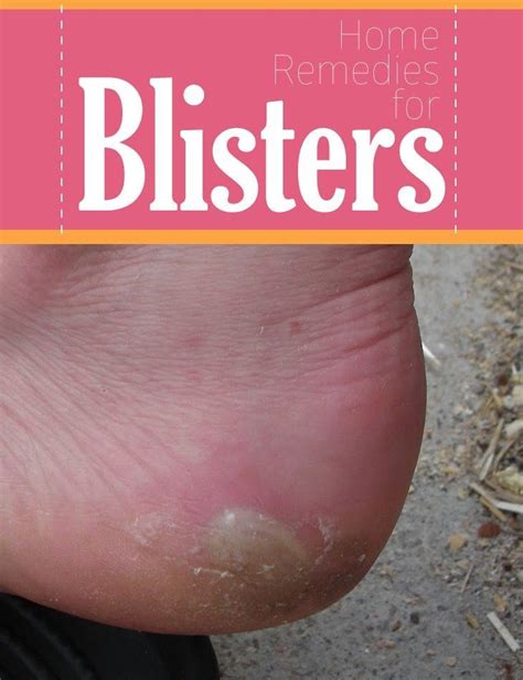 Home Remedies For Blisters Pin Remedies Remedies Home Remedies