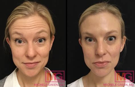 What Causes An Eyebrow Droop Ptosis After Botox Avoiding Bad Botox