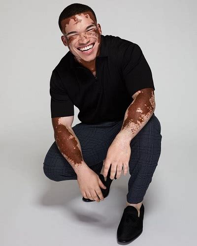 Curtis Mcdaniels Journey From A Shy Teenager To A Bold Vitiligo Model
