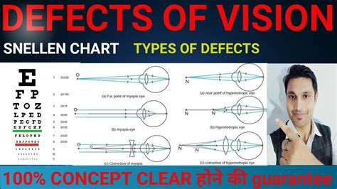 Defects Of Visiondefects Of Eyessnellen Chart Youtube