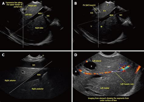 Ultrasound Anatomy Of Liver Anatomical Charts And Posters