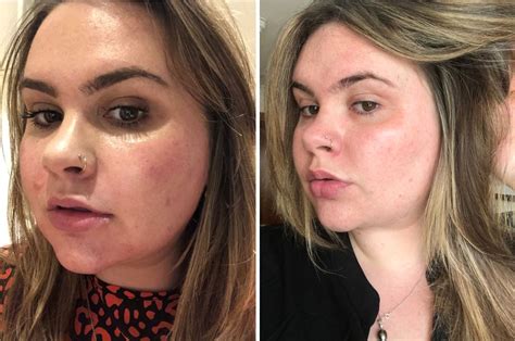 “i Had Hyaluronic Acid Injected Into My Face And This Is What Happened