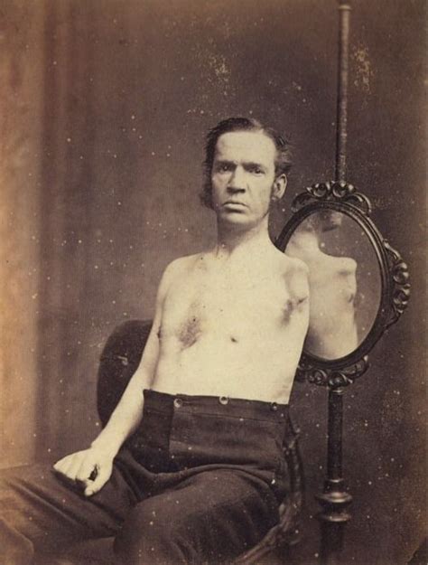 Tuesday Johnson Ca 1874 Portrait Of A Gentleman Who Underwent A