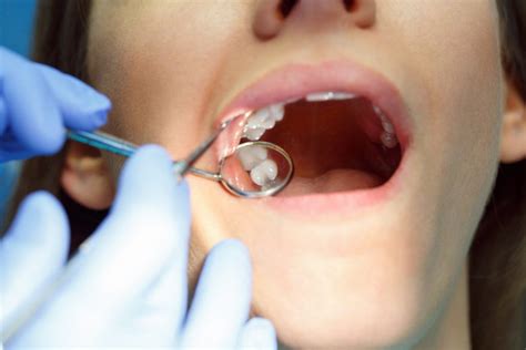 What Age Does Wisdom Teeth Come In Boston Dentist Congress Dental