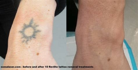 Does Laser Tattoo Removal Scar Tattoo Design
