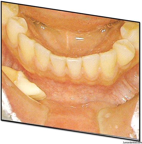 Tooth Avulsion Exarticulation Of Tooth Treatment And Management