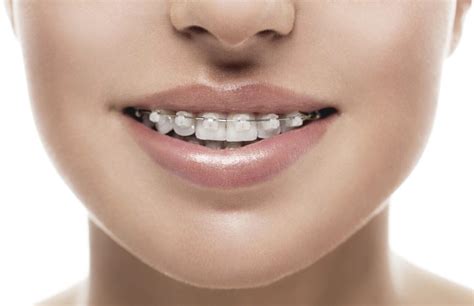 The Average Cost Of Braces Bracesetters
