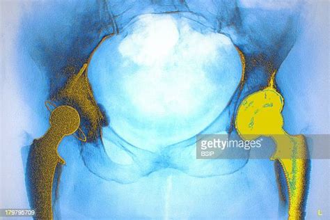 Total Hip Arthroplasty Photos And Premium High Res Pictures Getty Images
