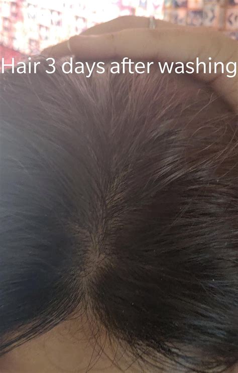 Dry Scalp Not Dandruff How Can I Get Rid Of This 😭i Have Dry Skin