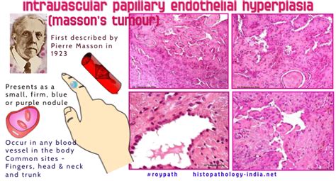 Pathology Of Intravascular Papillary Endothelial Hyperplasia Massons