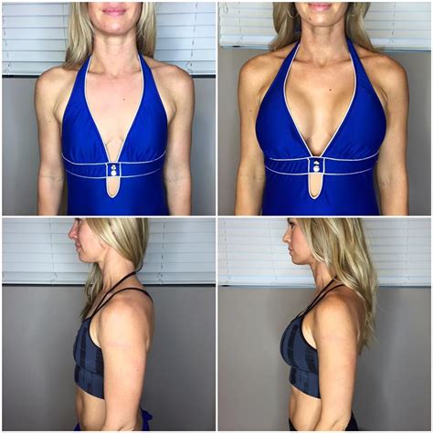 Breast Augmentation Before And After A To C