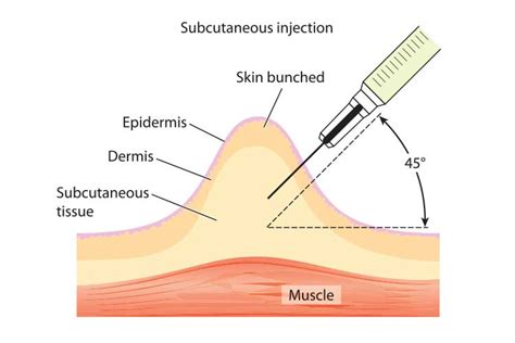 Administering Subcutaneous Injections Ausmed