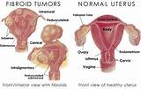 Pictures of Holistic Treatment For Fibroid Tumors