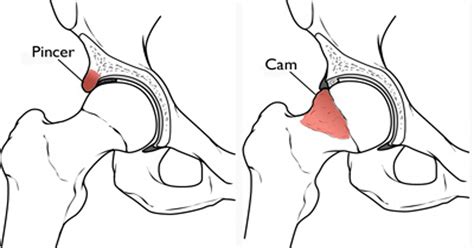 The Injury Zone Common Hip Conditions