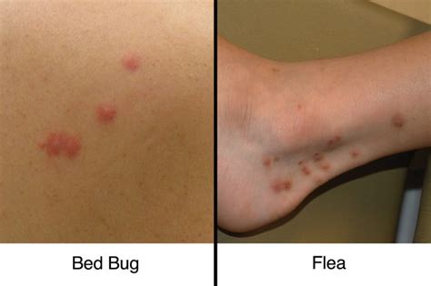 Bed Bug Bites Vs Fleabites How To Tell The Difference The Healthy