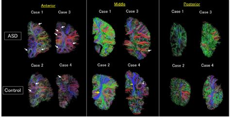 Diffusion Tensor Imaging Dti Tractograpy The Color Coding Of