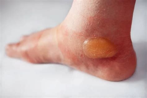 Foot Blister Images Search Images On Everypixel