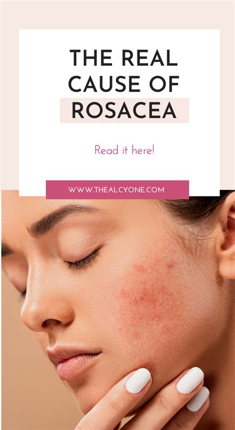 Rosacea Causes Triggers And Skincare Routine For Rosacea Artofit