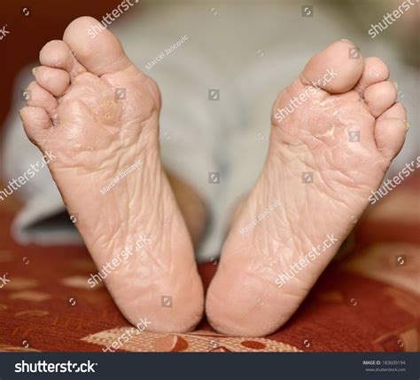 Fungus Infection On Mans Foot Callus Stock Photo Edit Now