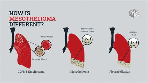How Is Mesothelioma Different Elg Law
