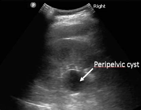 Ultrasound Guide Cysts