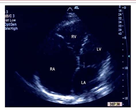 Figure 1 From Idiopathic Dilation Of The Right Atrium In Asymptomatic