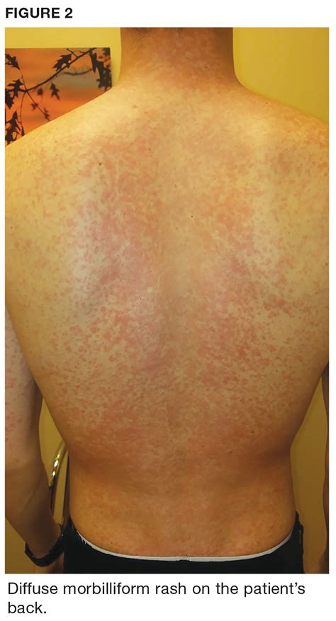 Man 25 With Sinus Pain Sore Throat And Rash Clinician Reviews