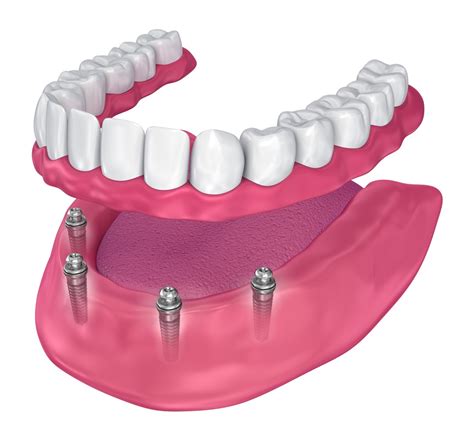 The secret lies in placing those implants. What is the approximate cost of full dental implants ...