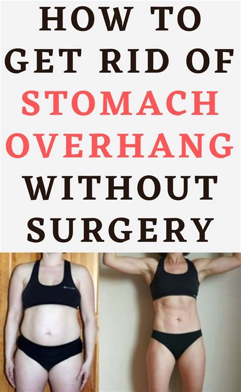 10 Tips On How To Get Rid Of Stomach Overhang Without Surgery Hello Healthy Blog