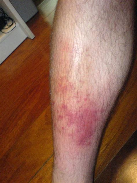 Érysipèle sur la jambe érysipèle de jambe traitement les remèdes populaires jambes